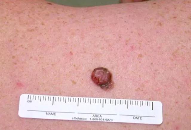 5招教你辨别痣和瘤,怎样区分痣和瘤