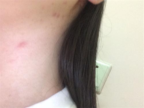 成人痘最佳治疗方法,成人痘痘不留疤痕祛除法