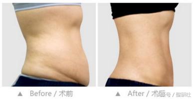 什么身材适合做腹壁整形,腹壁整形术前后恢复效果图