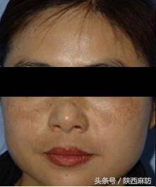 褐青色斑什么季节做比较好,褐斑有哪些