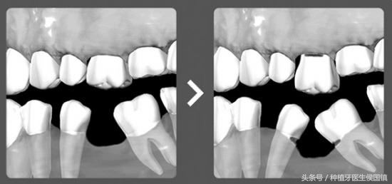 蛀牙坏了一半要根管治疗吗,蛀牙整颗烂到只剩牙根要拔吗