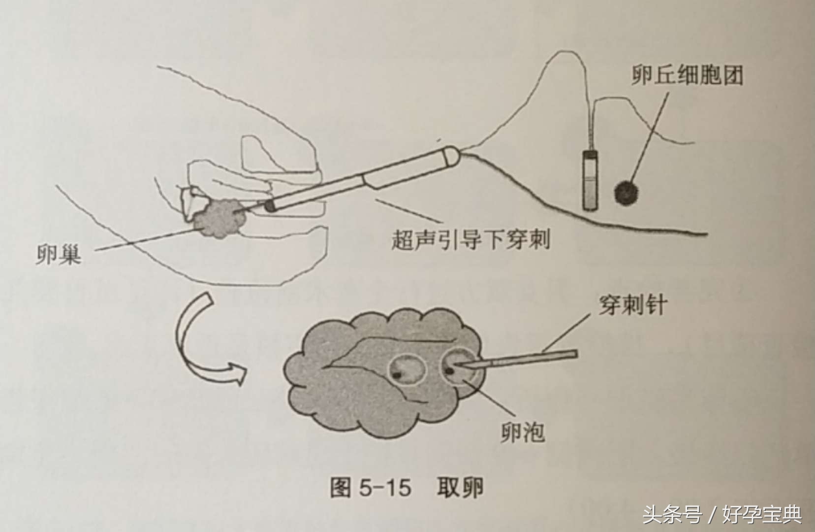 试管婴儿流程及治疗费用,可以做试管婴儿的条件有哪些