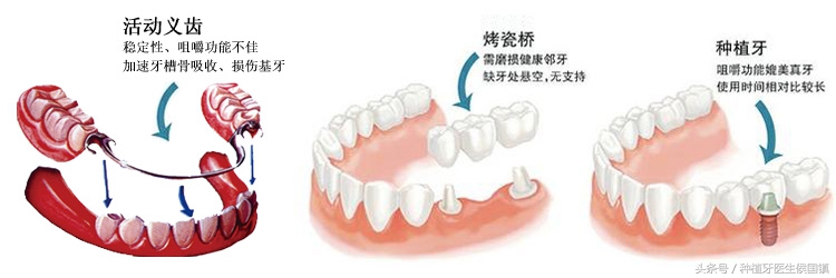 蛀牙坏了一半要根管治疗吗,蛀牙整颗烂到只剩牙根要拔吗