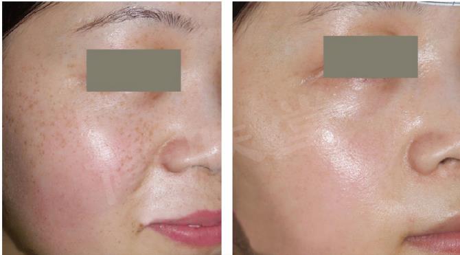 40多岁女性脸上斑多是怎么回事,40岁长斑的女性吃什么祛斑最好