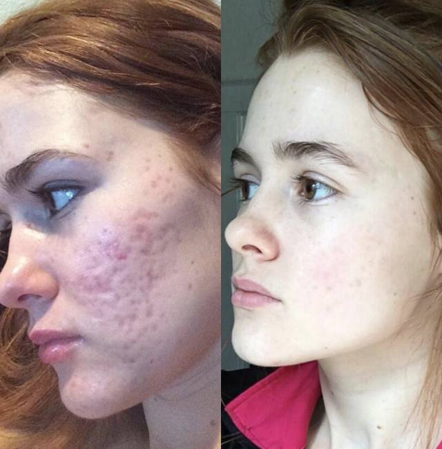 360°真实记录从满脸痘到痊愈，她红遍了Ins