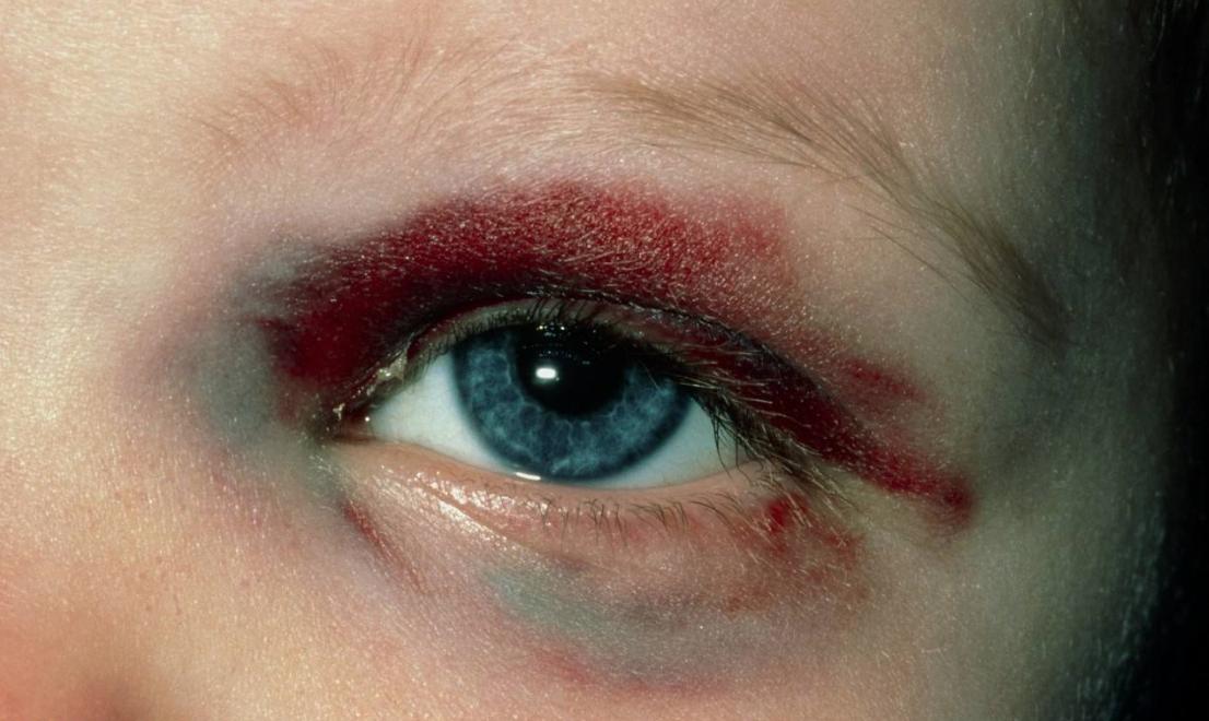 家长警惕：孩子一只眼大、一只眼小，可能是摊上了一种病