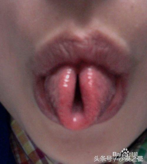 打呼噜最快治疗方法小妙招,把舌头往上卷能治打呼噜吗