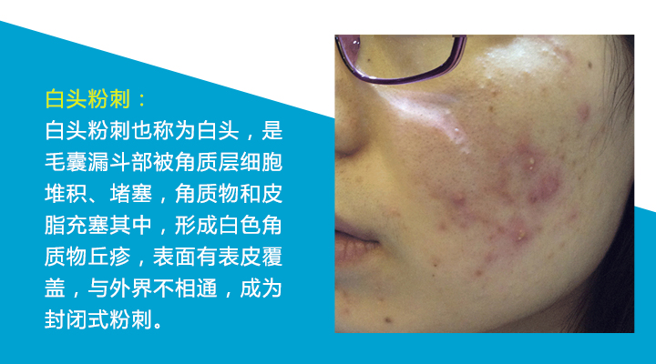 八种痘痘,九大部位的痘痘