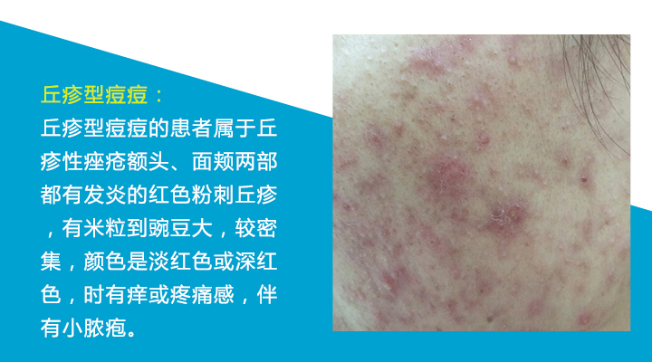 八种痘痘,九大部位的痘痘