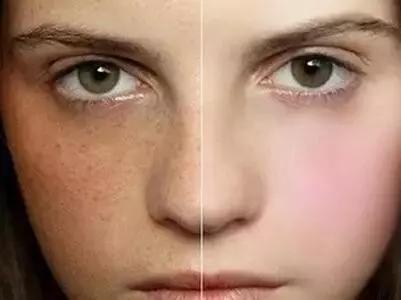 褐青斑的治疗,治疗褐斑的最佳方法