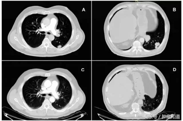 世界第一例cart疗法治愈晚期肝癌,世界第一例cart治愈晚期肝癌