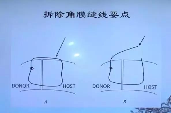 徐建江教授：角膜移植术后屈光不正的矫正