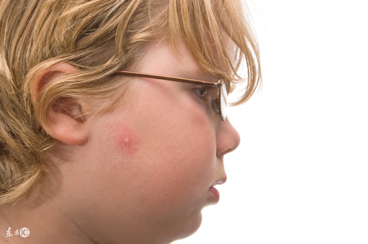 痘痘怎么挤不出血,痘痘要挤到什么程度才算挤干净