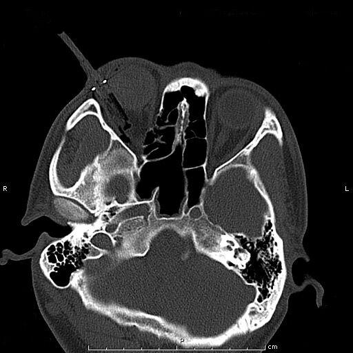 眼部穿透异物取出手术后多久恢复,眼二科独立手术成功案例
