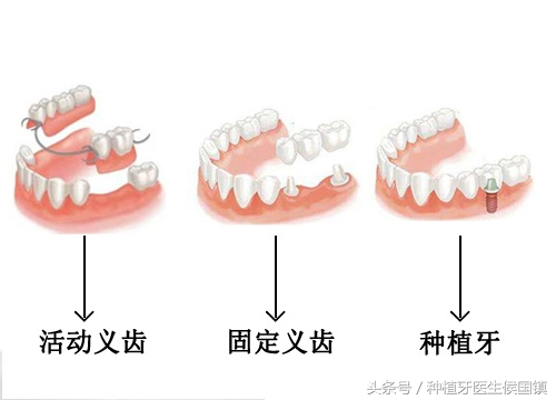 无缘无故掉了一颗牙齿有什么预兆,50岁牙齿掉了一颗是补牙还是植牙