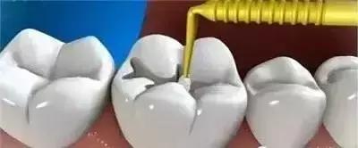 补牙怎么补性价比最高,省口腔医院补牙价格表