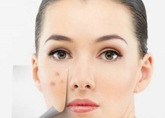 长痘皮肤注意清洁控油补水,痘痘肌要怎么护理才不会重复长痘