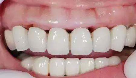 做烤瓷牙后悔的人,做烤瓷牙的人都后悔吗