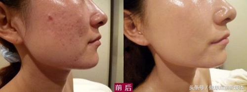 脸上有老人斑怎么去掉,脸上的斑怎么才能去掉呢