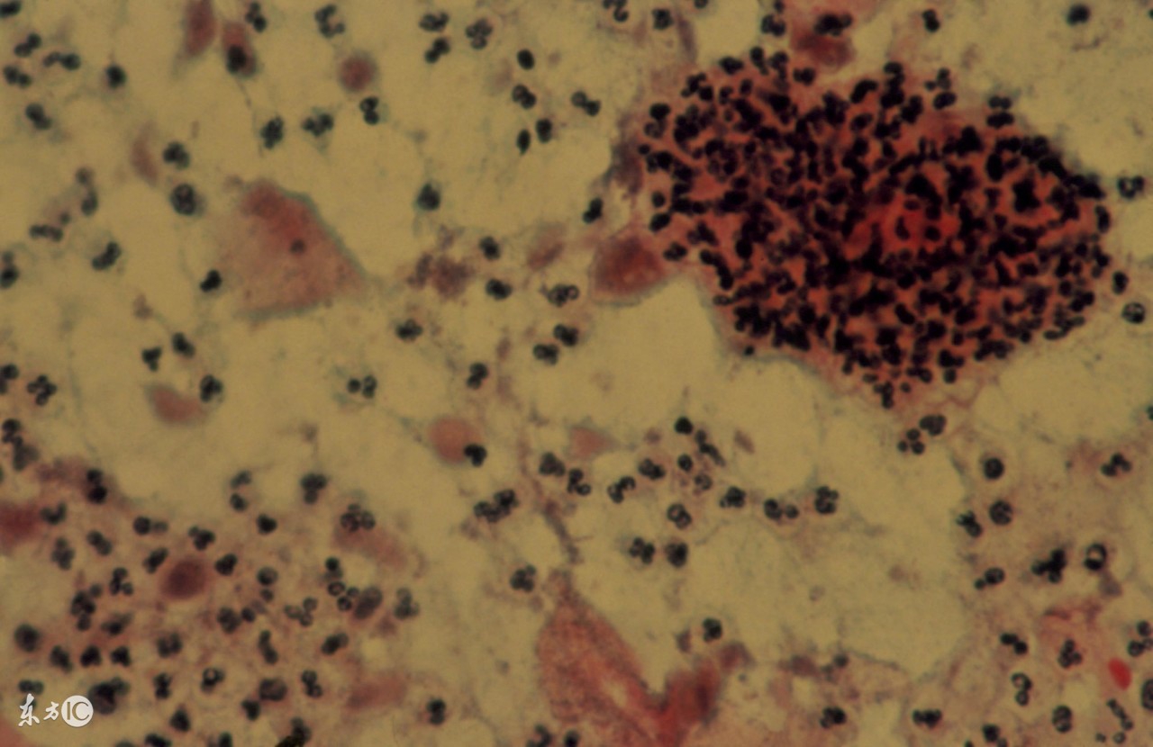 女性宫颈炎怎么治疗最好,急性宫颈炎是什么原因引起的