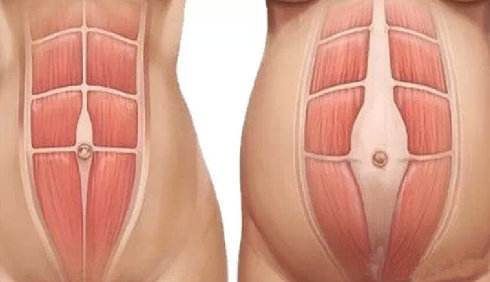 产后修复，不仅只有瘦瘦瘦