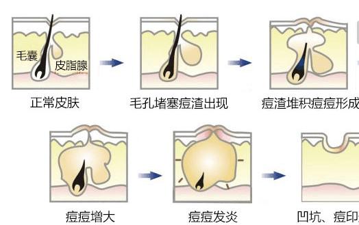 一张脸别被痘印毁了，怎么预防痘印，痘印怎么消除
