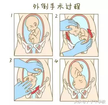 胎位中最常见的异常胎位,什么样的胎位好生