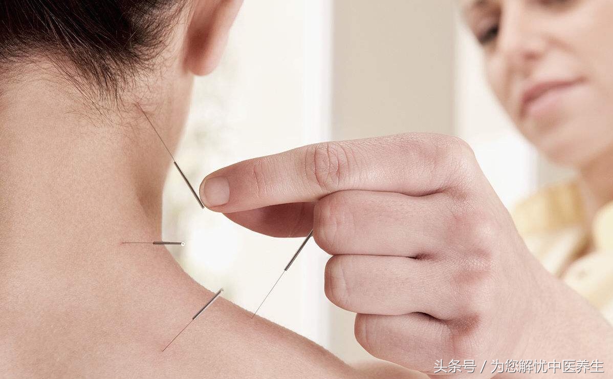 针刺治疗面瘫的图片,面瘫最佳针刺疗法视频