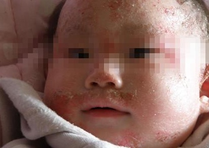 婴儿脸上疹子,婴儿疹子