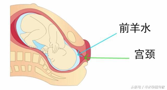 临产破水怎么躺,临产怎么看破水