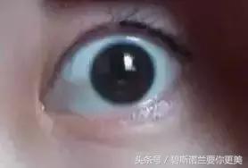 碧*诺斯**兰要你更美：用手抠掉痂皮，没色你怪谁？