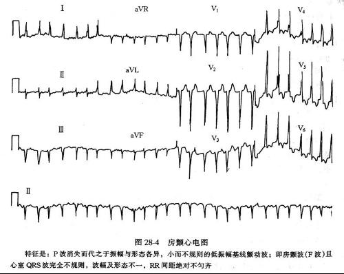 心脏房颤治疗需要多少钱,电复律治疗房颤对心脏有损害吗