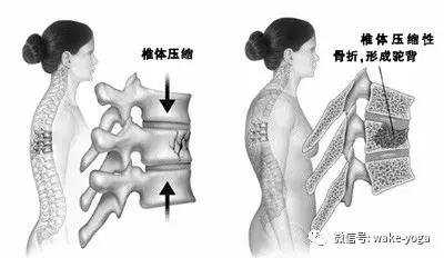 如何告别驼背,不要让驼背影响你的气质