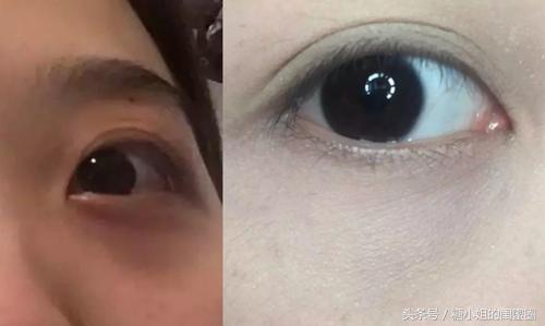 怎么拯救眼袋和泪沟,如何才能拯救我的黑眼圈大眼袋