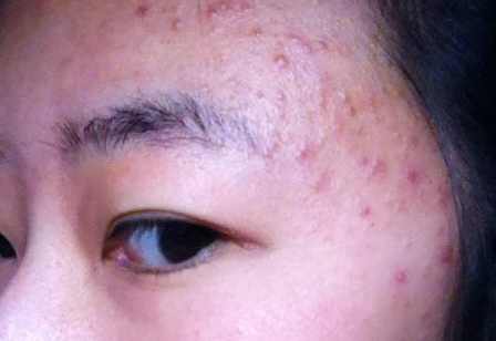 什么原因导致毛囊炎怎么彻底根治,毛囊炎怎么患上的