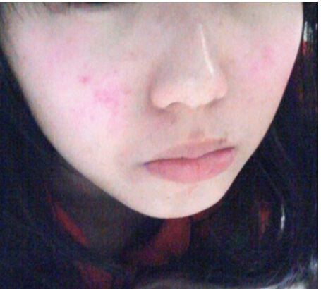 以前皮肤不过敏现在过敏怎么回事,皮肤过敏为什么吃过敏药没有效果