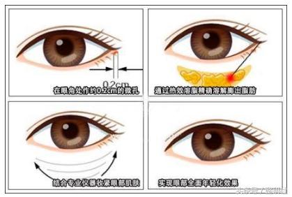 无痕去眼袋案例分享,微创无痕去眼袋