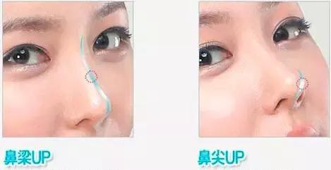 假体隆鼻都有什么术式,假体隆鼻一般用什么材料