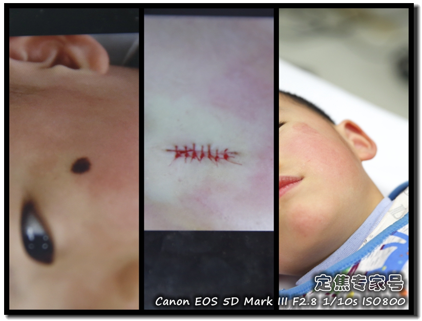 头皮一块一块的红斑,头皮癣治疗要多少钱