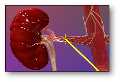 高血压肾动脉交感神经射频消融术,肾动脉消融术治疗原发高血压