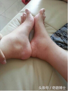 孕晚期水肿和羊水过少有关吗,孕期水肿得厉害怎么缓解