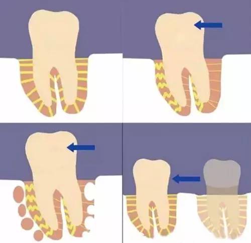 隐形矫正真的那么好吗？赵美牙带你破解隐形矫正五大谣言
