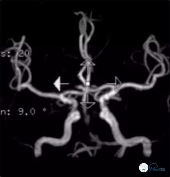 天坛医院脑血管狭窄手术做得好吗,天坛医院动脉狭窄介入手术费用