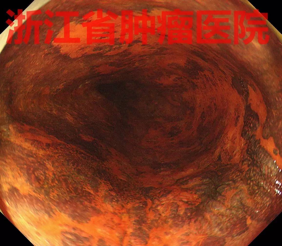 食管大面积黏膜病变，看看这家医院如何处理？！