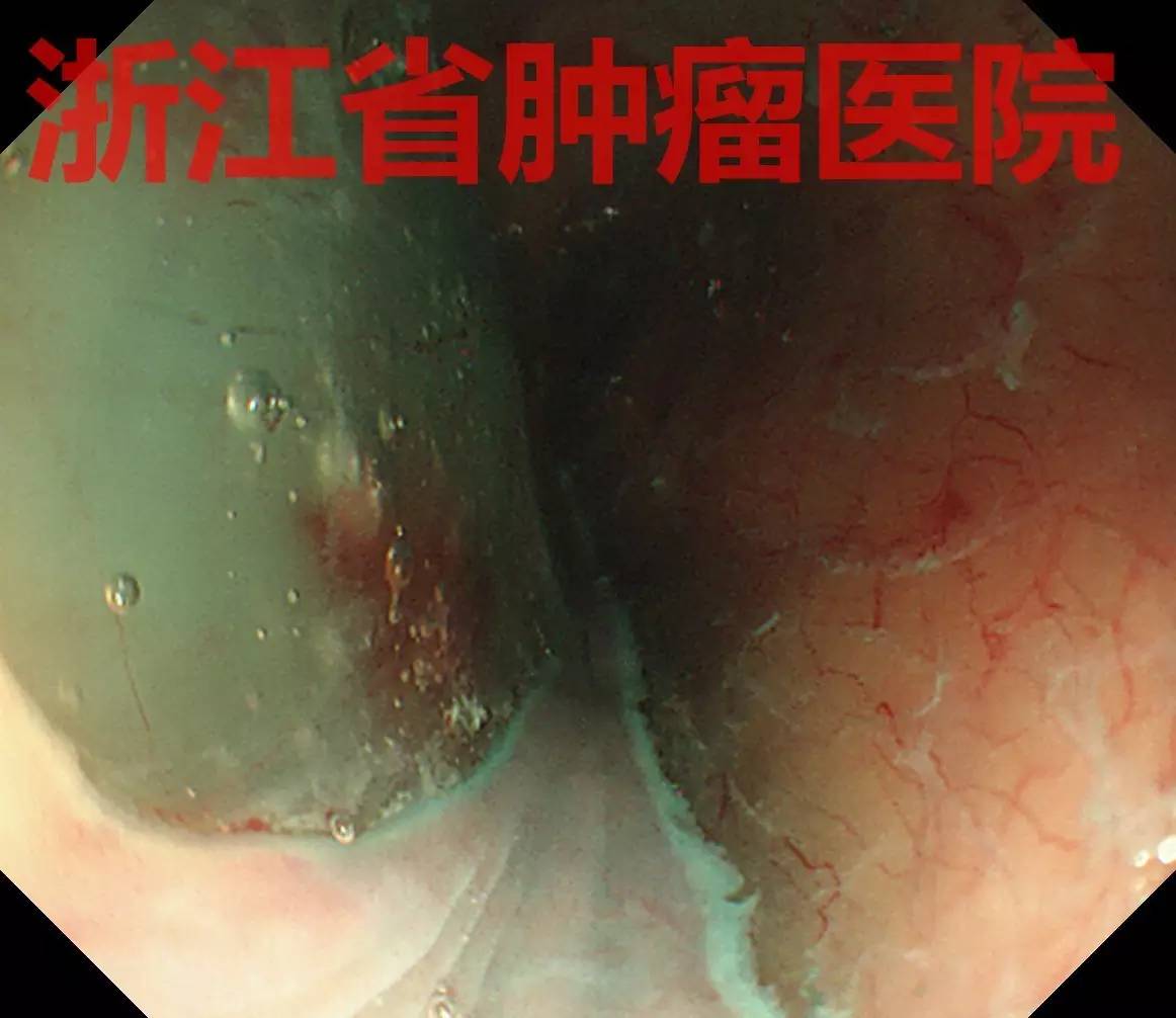 食管黏膜病变越大就一定是恶性吗,食管病变严重需要怎么治疗
