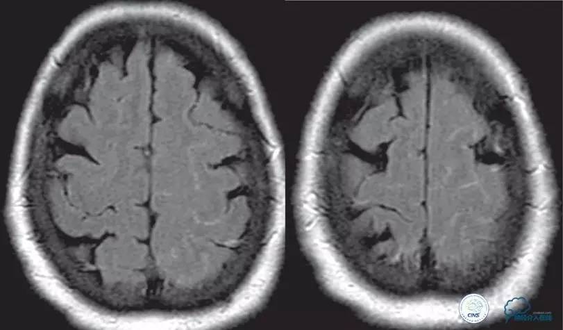 急性缺血性卒中静脉溶栓2018指南,急性缺血性卒中血管内再通标准