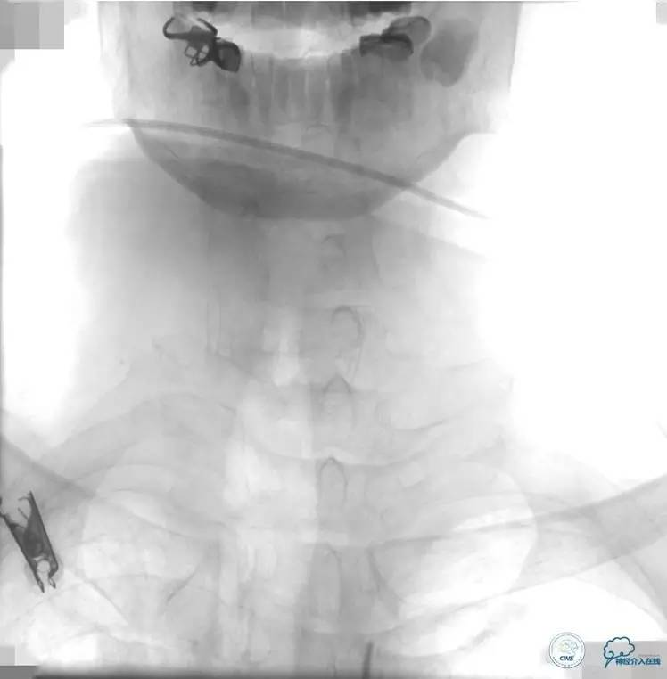 急性缺血性卒中静脉溶栓2018指南,急性缺血性卒中血管内再通标准