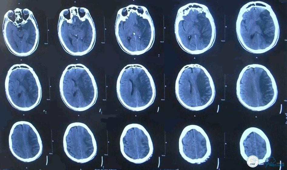 急性缺血性卒中静脉溶栓2018指南,急性缺血性卒中血管内再通标准