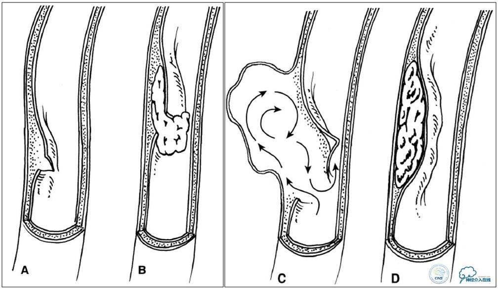 颈椎压迫椎动脉按摩正骨行吗,按摩斜角肌会导致椎动脉夹层吗