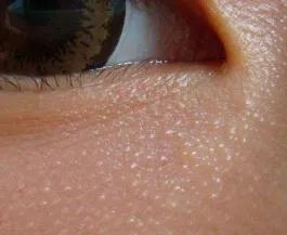 脸上能挤出白色小东西是什么,脸上鼻头挤出白色颗粒